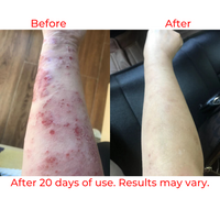 Refine Naturals™ ECZEMA